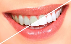 Λεύκανση δοντιών: τι είναι και πότε εφαρμόζεται