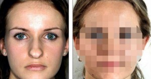 Δείτε πως μπορεί μια εγχείρηση πλαστικής στη μύτη να αλλάξει εντελώς το πρόσωπο ενός ατόμου