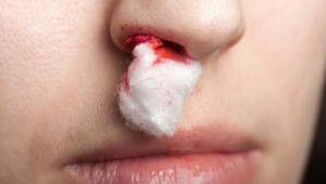 Αίμα από την μύτη: Τα σωστά βήματα για την σταματήσετε