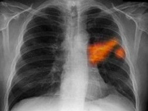 Δείτε την ουσία που μπορεί να καταστρέψει το 90% των κυττάρων του καρκίνου του πνεύμονα!