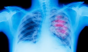 ΜΕΓΑΛΗ ΠΡΟΣΟΧΗ - 9 Σημάδια για τον καρκίνο των πνευμόνων που πρέπει να ξέρετε.