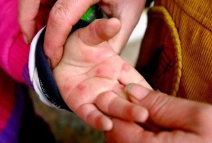 ΠΡΟΣΟΧΗ: Ο ιός Κοξάκι σε έξαρση στα παιδιά! Δείτε πώς να προφυλαχθείτε