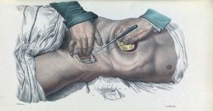 Πώς γίνονταν οι χειρουργικές επεμβάσεις το 1840. Συγκλονιστικές εικόνες από χειρουργεία χωρίς αναισθητικό
