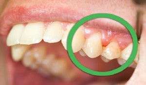 Φυσικές θεραπείες για ούλα που ματώνουν και δόντια που κουνιούνται