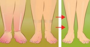 5 Χρήσιμες Συμβουλές για να Ανακουφίσετε τα Πρησμένα Πόδια σας με Φυσικό Τρόπο.