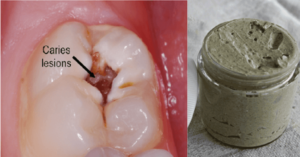 Αυτή η σπιτική οδοντόκρεμα αντιστρέφει την ουλίτιδα και λευκαίνει τα δόντια