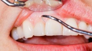 Όταν τρίβονται τα δόντια – Τι φταίει