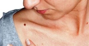 Πώς θα αφαιρέσετε εύκολα τις μικροσκοπικές ελιές από το δέρμα με μόνο ένα συστατικό!