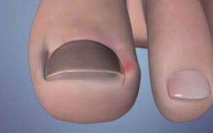 Αν γυρνάνε τα νύχια των ποδιών και μπαίνουν στο κρέας, μη στενοχωριέστε, υπάρχει λύση! Μπορείτε να την δείτε στο άρθρο μας και να απαλλαγείτε!