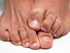 ΕΠΙΣΤΗΜΟΝΙΚΗ ΑΠΟΚΑΛΥΨΗ ΠΟΥ ΣΟΚΑΡΕΙ! Τα νύχια των ποδιών σας δείχνουν αν κινδυνεύετε από καρκίνο