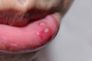 Άφθες στο στόμα: Αίτια, συμπτώματα, αντιμετώπιση και πρόληψη [vid]