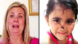 Μητέρα υιοθετεί 3χρονο ορφανό που ζώα έφαγαν τη μύτη του- Δείτε όμως τη μεταμόρφωση του μετά από λίγα χρόνια... (βίντεο)