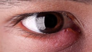 Κριθαράκι στο μάτι: 5 τρόποι σπιτικής αντιμετώπισης και πρόληψης