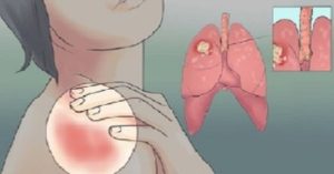 Προσοχή: ΑΥΤΑ τα Σημάδια Δείχνουν Πιθανό Καρκίνο του Πνεύμονα