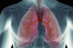 Πνευμονικό οίδημα: Προσοχή στα συμπτώματα – Τι πρέπει να κάνετε άμεσα!