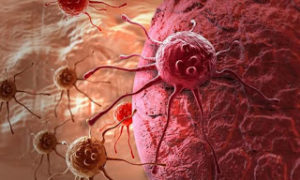 Καρκίνος του στομάχου: Ποια τα απλά συμπτώματα που πρέπει να προσέχετε