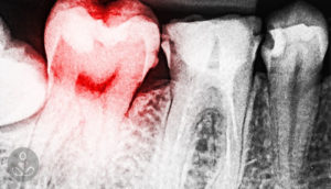 Τα αποστήματα στα Δόντια είναι άκρως Επικίνδυνα. Δείτε 11 Σπιτικά Γιατροσόφια για να τα αντιμετωπίσετε!
