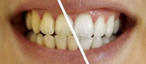 «Μαγικό» διάλυμα με φυσικό τρόπο για τα δόντια - Δείτε «λευκά» αποτελέσματα σε 3 λεπτά!