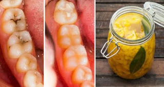 Πως να Θεραπεύσετε Τερηδόνα και Κουφάλες στα Δόντια με 3 Απλές, Φυσικές  και Αποτελεσματικές Θεραπείες