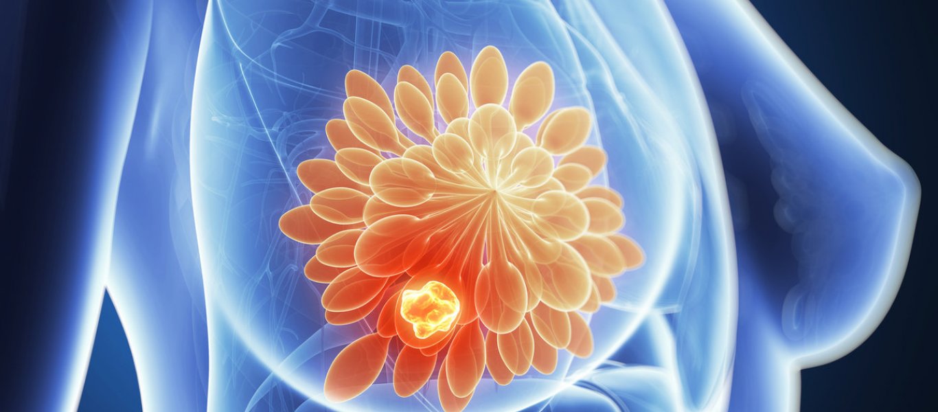 Επιστήμονες μετατρέπουν επιτυχώς τα κύτταρα του καρκίνου του μαστού σε λίπος για να τα σταματήσουν τη διάδοση